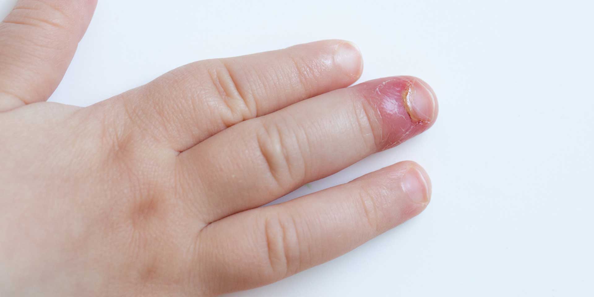 Ein Babyfinger mit einer Verletzung an der Spitze, sichtbar geschwollen und gerötet.