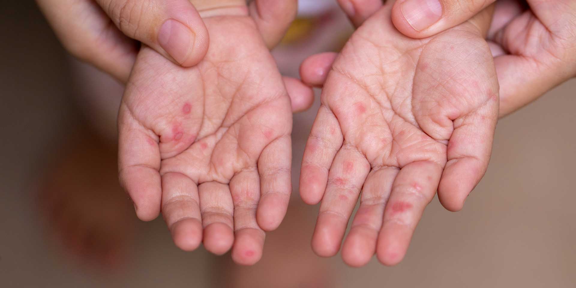 Hände von Erwachsenen und Kind zeigen kleine Rötungen und Verletzungen auf der Haut.