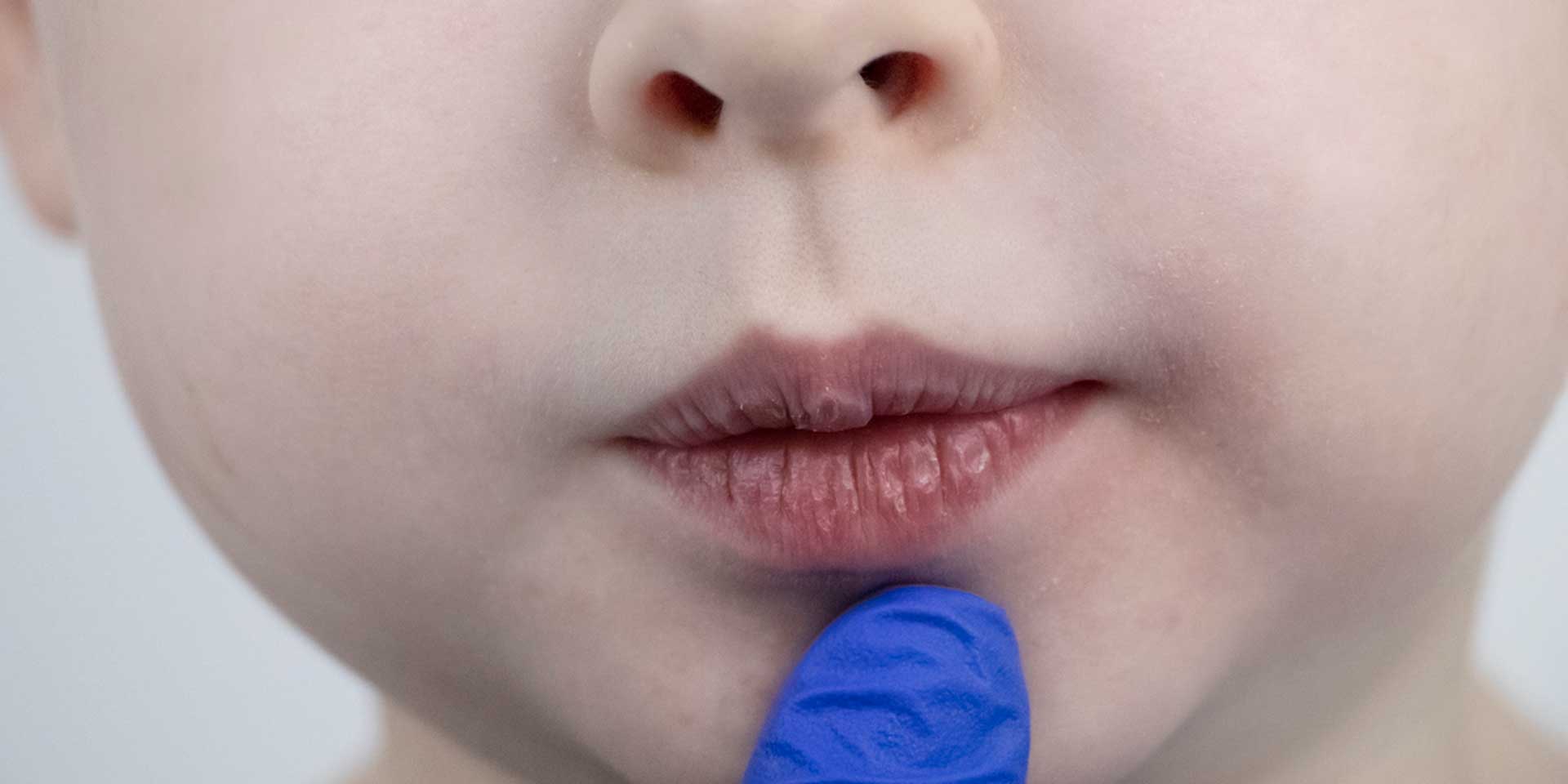 Nahaufnahme eines Kindes mit einem blauen Gegenstand am Kinn.